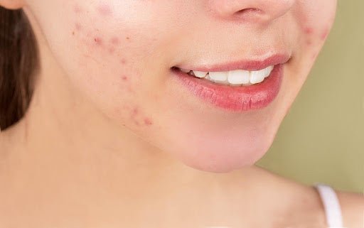 L’acné : tous les détails sur ce problème de peau ! - The Eco Shop